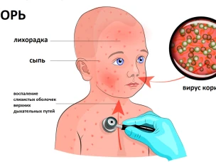 Профилактика кори