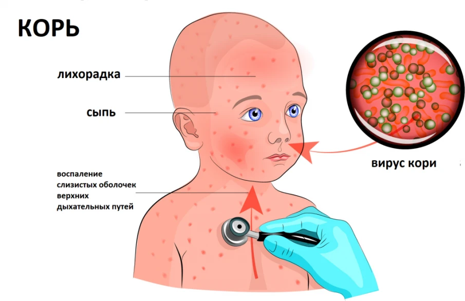 Профилактика кори